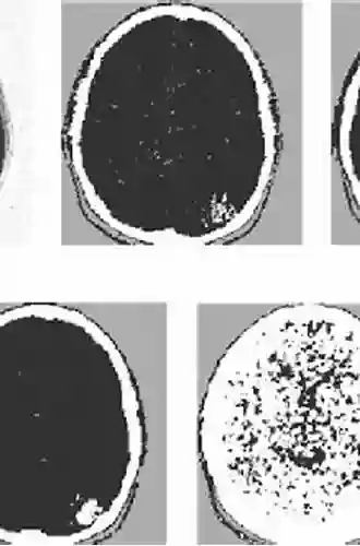 Medical Image Processing: Advanced Fuzzy Set Theoretic Techniques