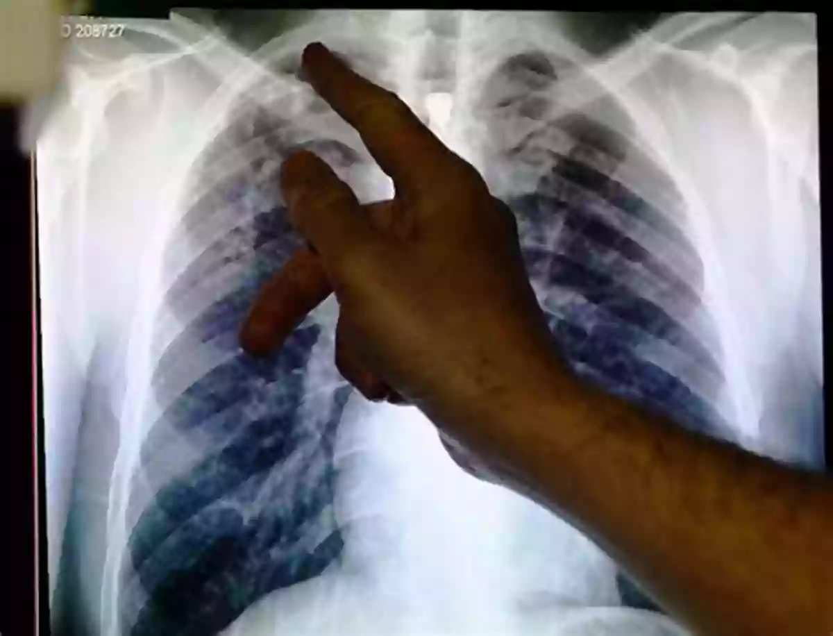 A Chest X Ray Showing The Characteristic Signs Of Tuberculosis Infection In The Lungs. Perspectives On Type 2 Diabetes (HIV TB And Non Communicable Diseases 1)