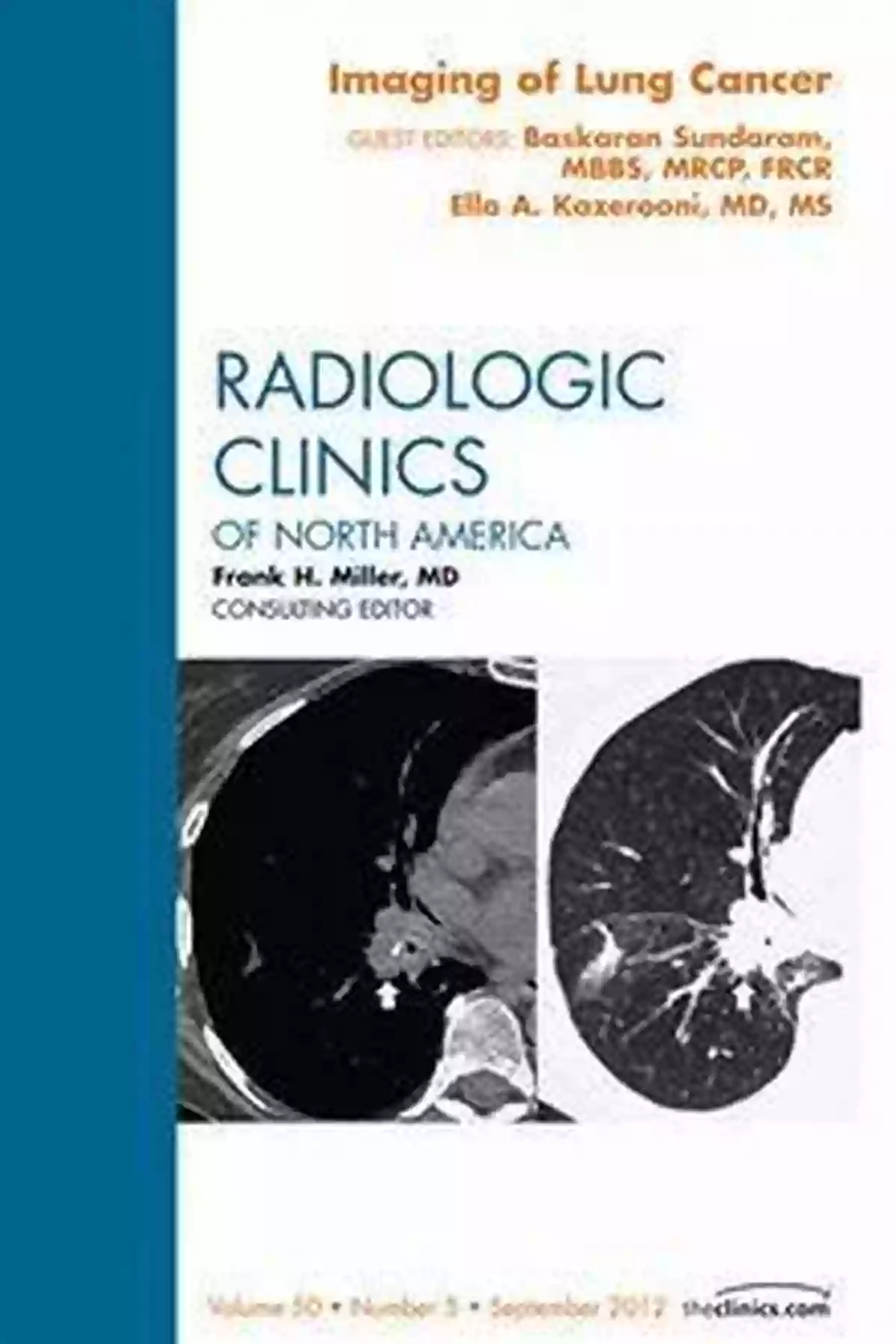 Lung Cancer An Issue Of Radiologic Clinics Of North America The Clinics Lung Cancer An Issue Of Radiologic Clinics Of North America (The Clinics: Radiology 56)