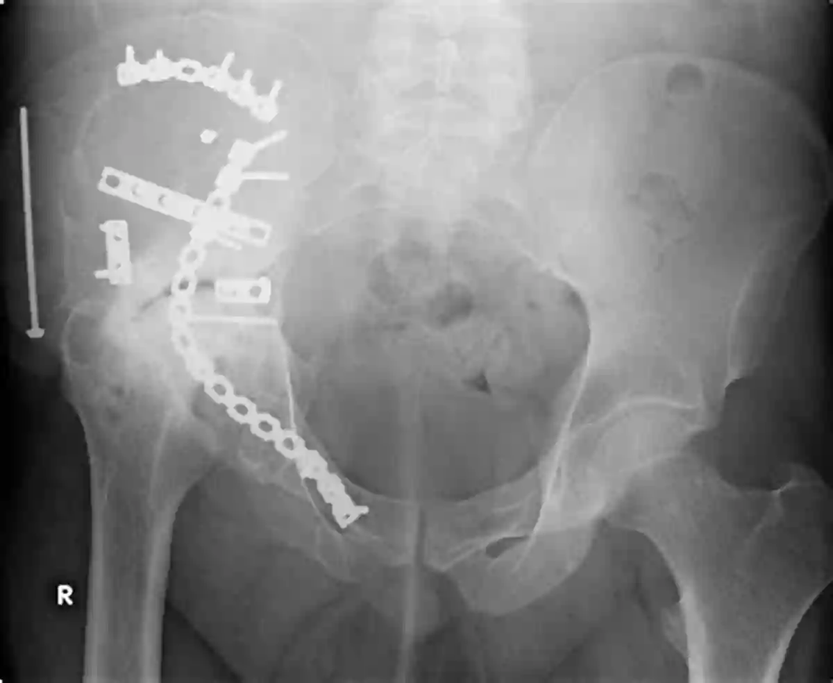 Radiology Of Orthopedic Implants Cross Radiology Of Orthopedic Implants A W Cross