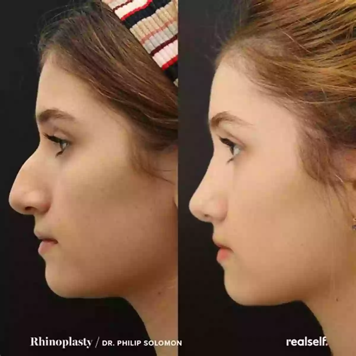 Woman Before And After Nose Job I Want A Big Nose: A About Opposites (Early Learning)